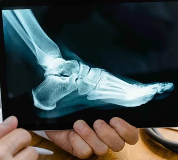 What is plantar fasciitis