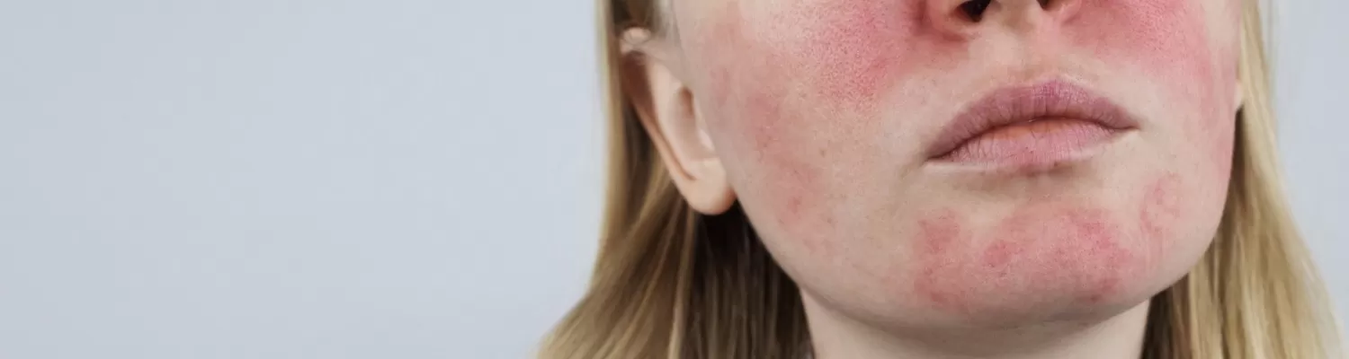 Rosacea And Menopause Image